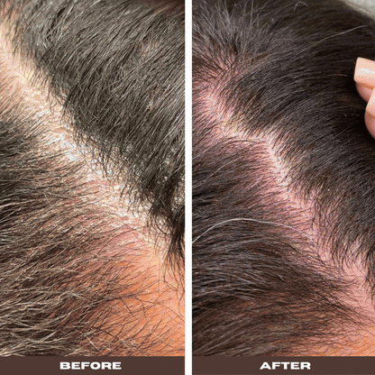 Seborrheic Scalp Solution Double Bundle | YeastDefense™️