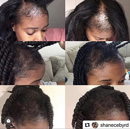 Edge Entity Hair Follicle Stimulant 2 Month Supply (Two Month) (5.3 Ounces)