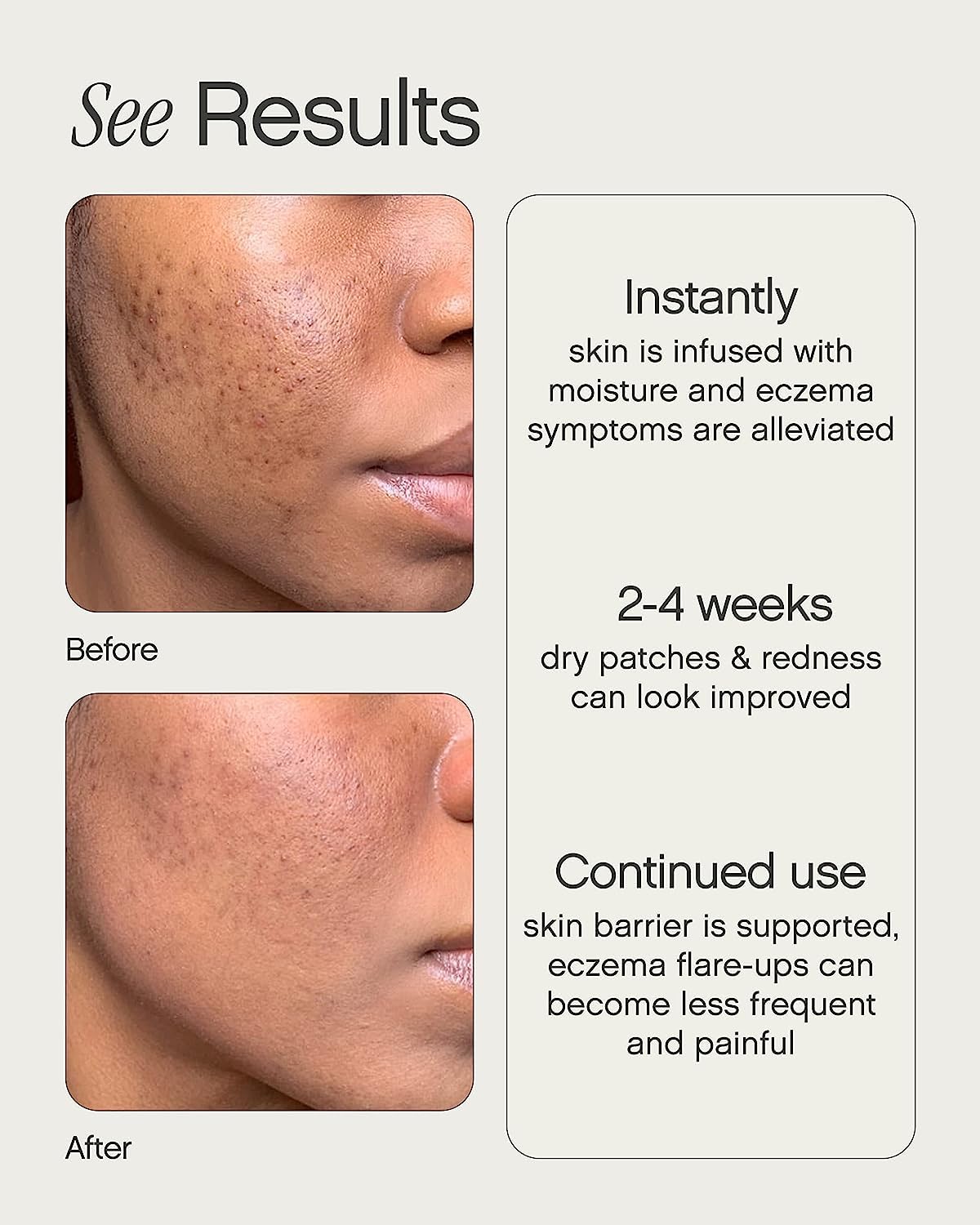 Topicals Like Butter Moisturizer for Dry, Sensitive & Eczema-Prone Skin - Soothing Instant Moisturizer and Eczema Relief for Face and Body, Skin Hydration (1.7 Fl Oz)