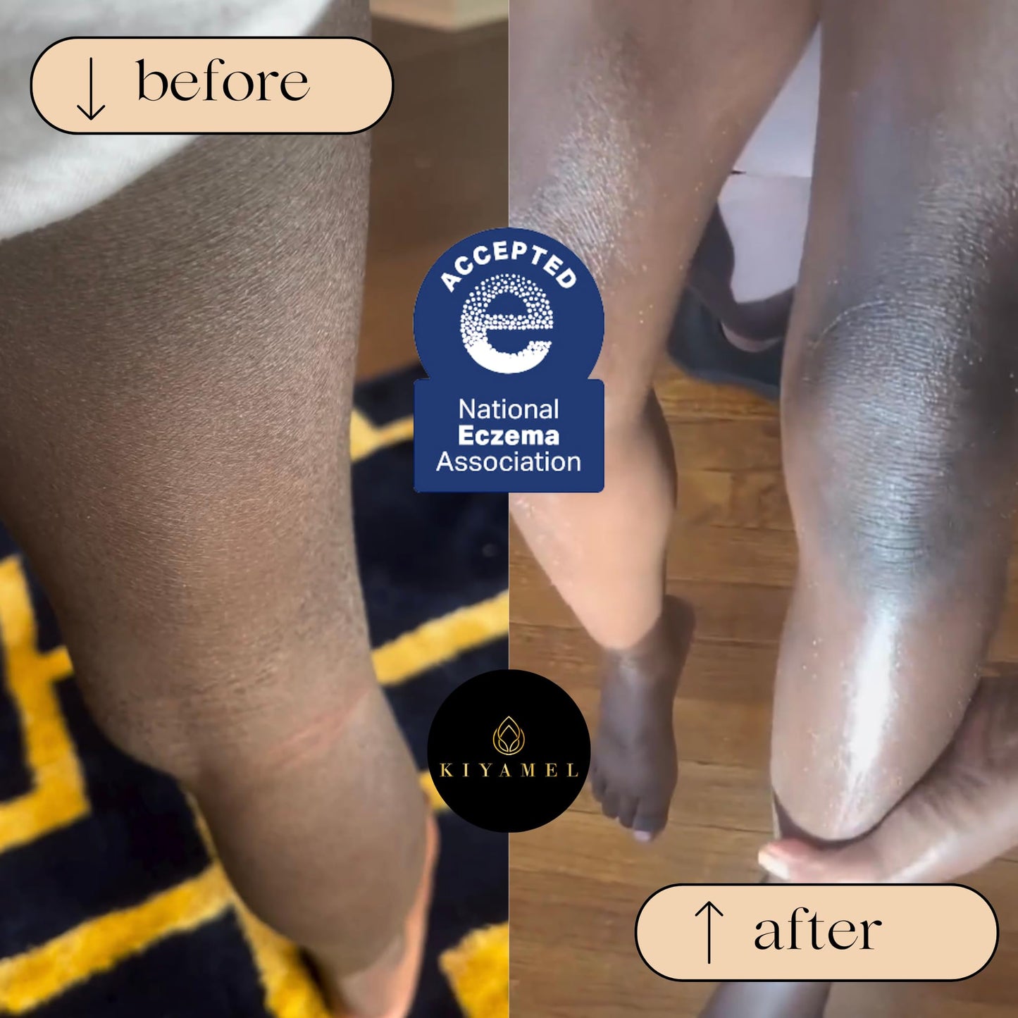 KIYAMEL | Moisturizing Eczema Relief Essential Baby Oil with Hemp Seed Oil for Dry, Itchy Skin, Soothing Moisturizer with Vitamin E and Chamomile, Revitalizing Hydration for Babies/Kids/Children