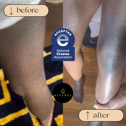 KIYAMEL | Moisturizing Eczema Relief Essential Baby Oil with Hemp Seed Oil for Dry, Itchy Skin, Soothing Moisturizer with Vitamin E and Chamomile, Revitalizing Hydration for Babies/Kids/Children