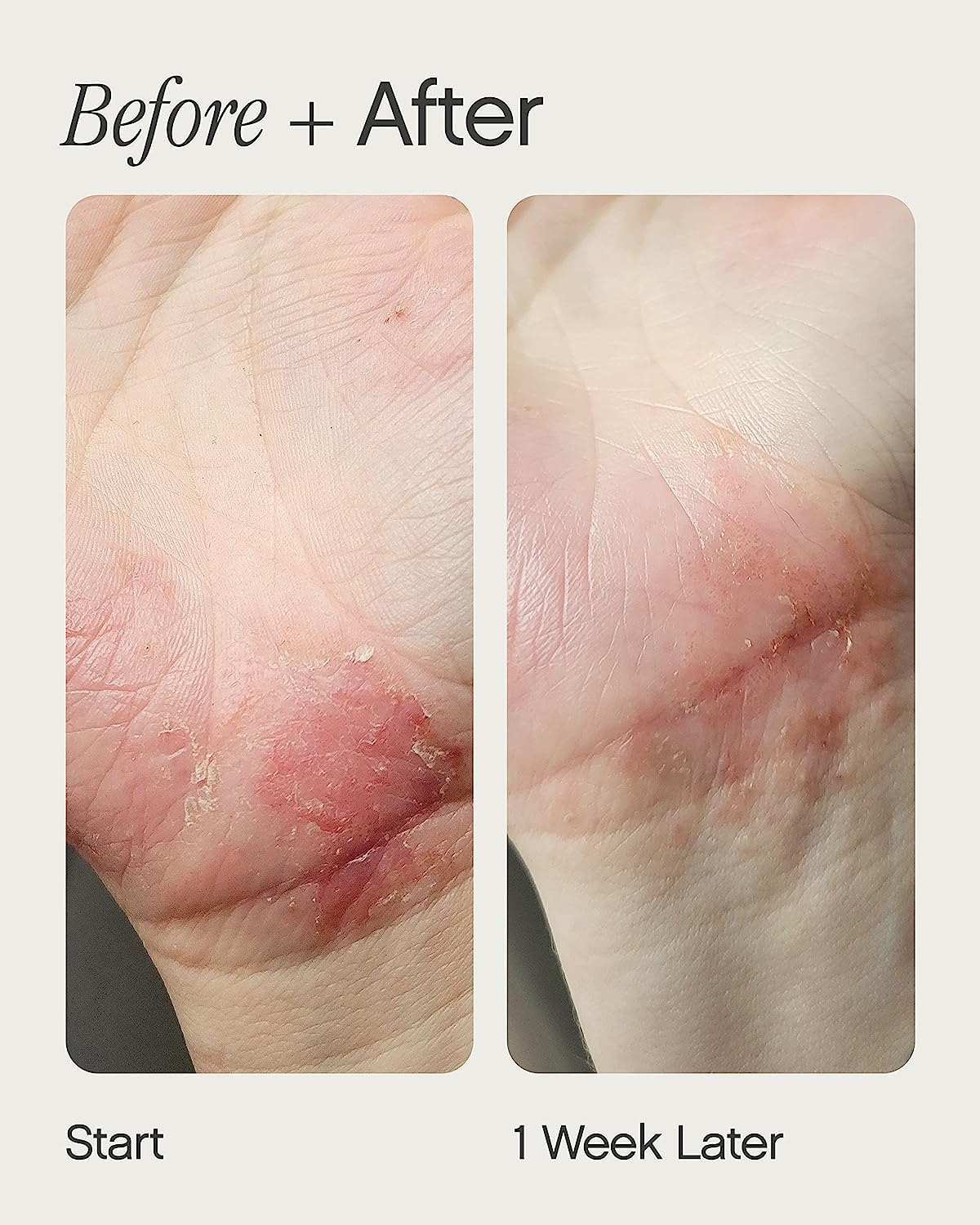 Topicals Like Butter Moisturizer for Dry, Sensitive & Eczema-Prone Skin - Soothing Instant Moisturizer and Eczema Relief for Face and Body, Skin Hydration (1.7 Fl Oz)