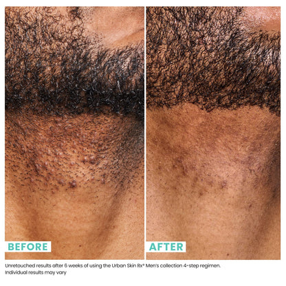 Urban Skin Rx Mens Daily Even Tone Moisturizer, Soothing, Lightweight Moisturizer for Men, Hydrating for Skin, Formulated with Hyaluronic Acid, Aloe, Niacinamide and Provitamin B5, 1.7 Fl Oz