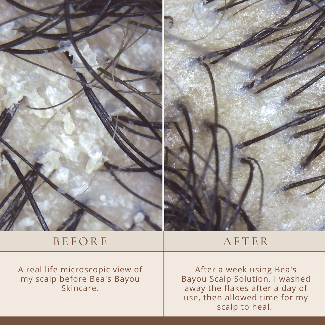Seborrheic Scalp Solution Double Bundle | YeastDefense™️