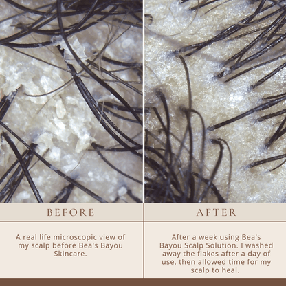 Seborrheic Scalp Solution Double Bundle | YeastDefense™️